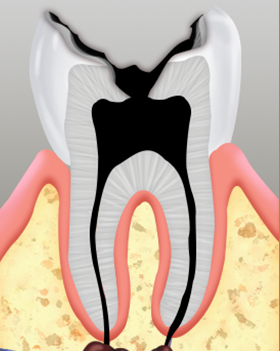 치수(신경)괴사