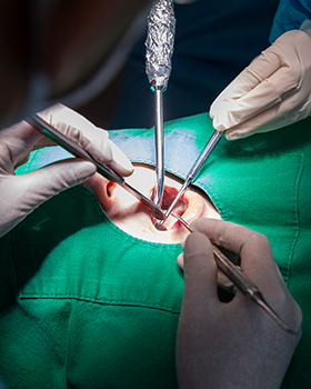 가이드를 이용한 수술